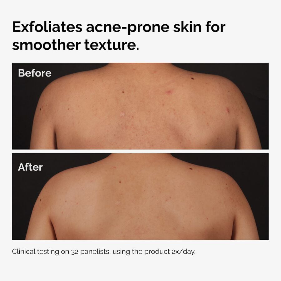 the-body-care-collection-f1 ord-salicylic-acid-body-serum-before-after-graphic-NA.jpg